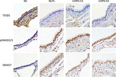 Transforming growth factor-β1 and SMAD signalling pathway in the small airways of smokers and patients with COPD: potential role in driving fibrotic type-2 epithelial mesenchymal transition